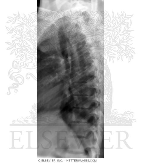 Lateral X-Ray of the Thoracic Spine