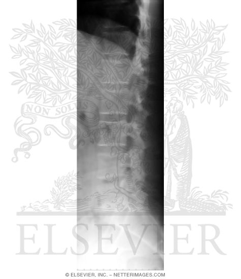Lateral X-Ray of Lumbar Vertebrae