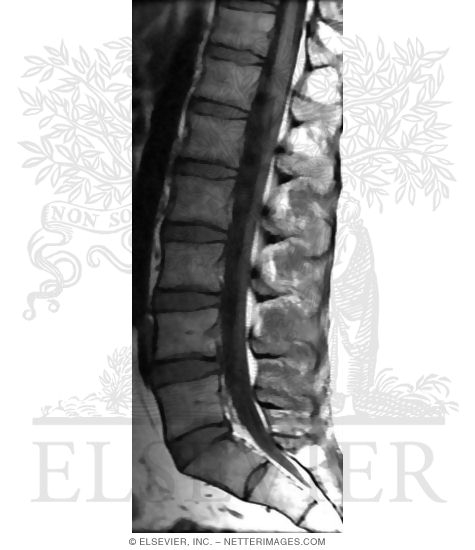 Watermarked preview of unlabeled image: Midsagittal T1 MRI Through Lumbosacral Vertebral Column and Spinal Cord