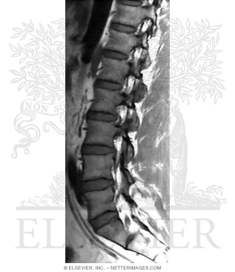 Watermarked preview of unlabeled image: Parasagittal T1 MRI In the Lumbosacral Region