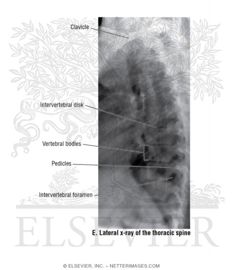 Lateral X-Ray of the Thoracic Spine