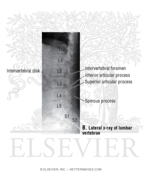 Lateral X-Ray of Lumbar Vertebrae