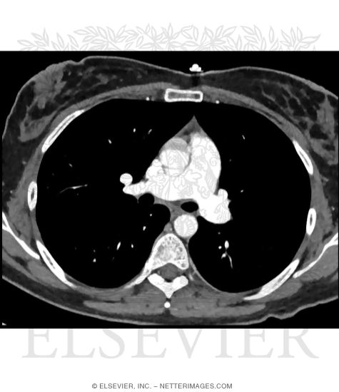 Soft Tissue (Mediastinal) Window: Level 70