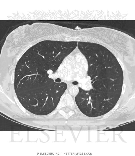 Lung Window: Level - 550