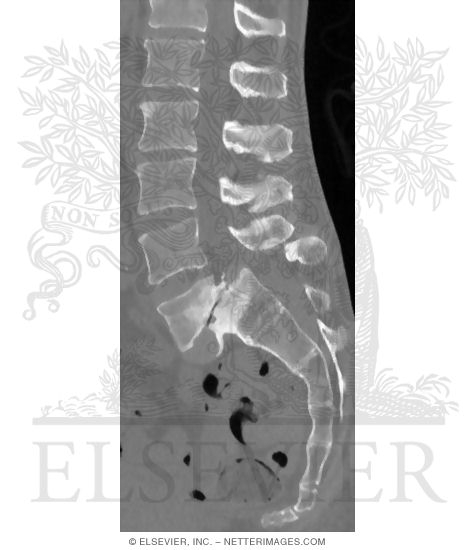 L5 Dislocation (Spondylolisthesis)