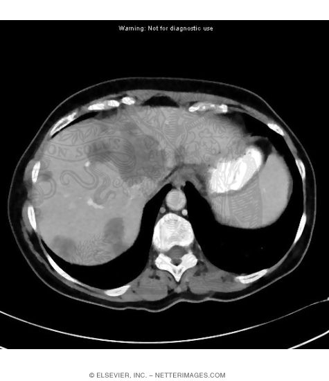 Liver Metastases