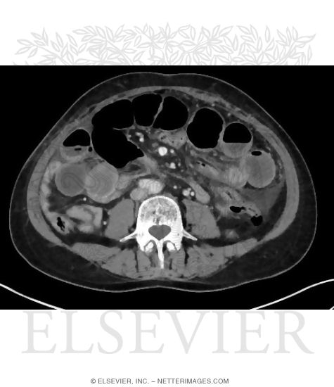 Dilated Small Intestine