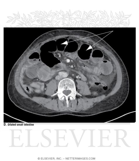 Watermarked preview of unlabeled image: Dilated Small Intestine
