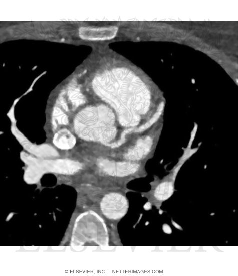 Heart and Pulmonary Vessels