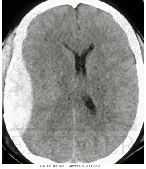 Epidural Bleeding