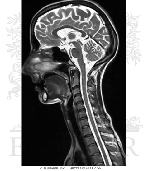 Fluid, Edema (T2 MRI)