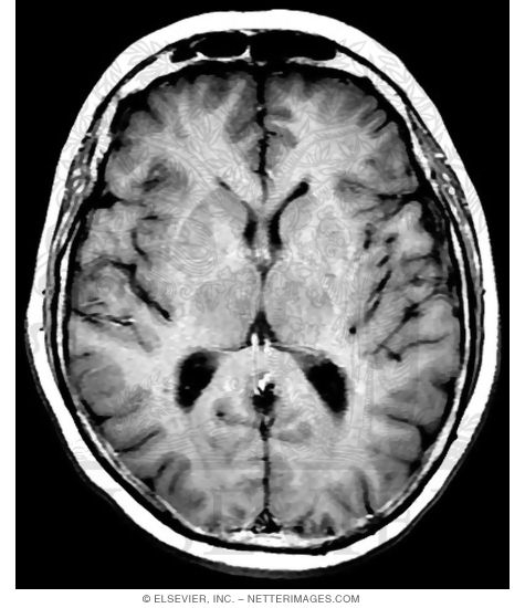 Gray Vs. White Matter In Brain