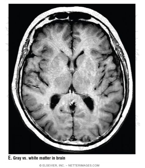 Gray Vs. White Matter In Brain