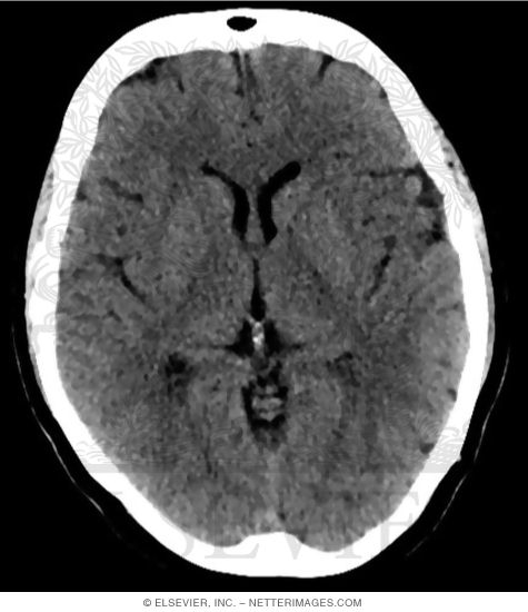 CT Soft Tissue Window Before Contrast