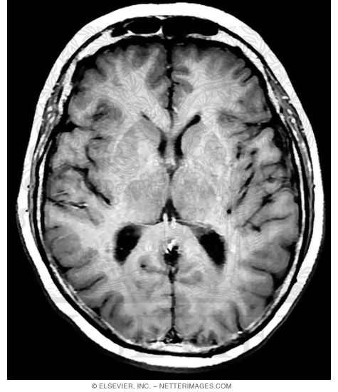 T1-Weighted MRI Before Contrast
