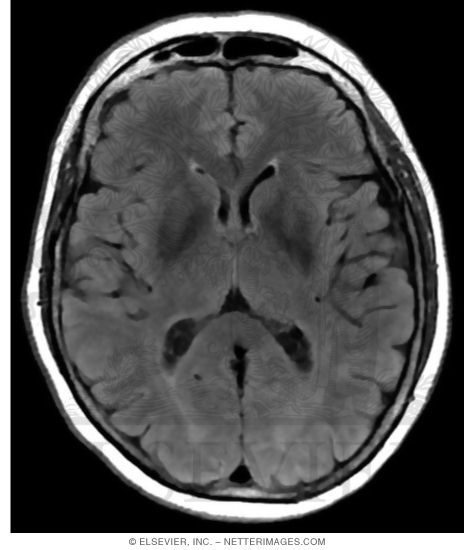 FLAIR MRI