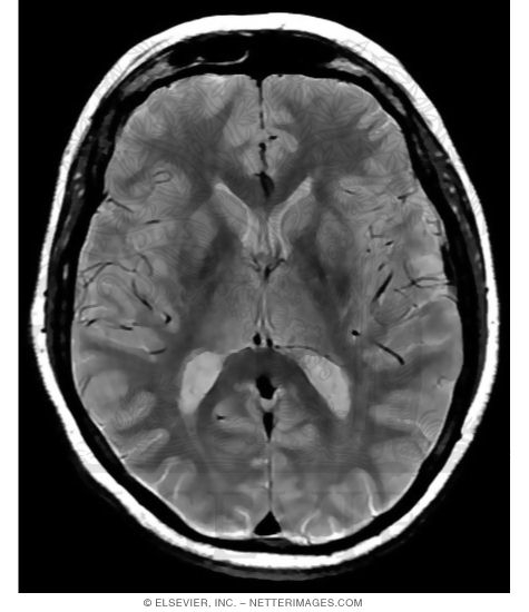 Proton Density MRIs Are Weighted Between T1- and T2-Weighted Images