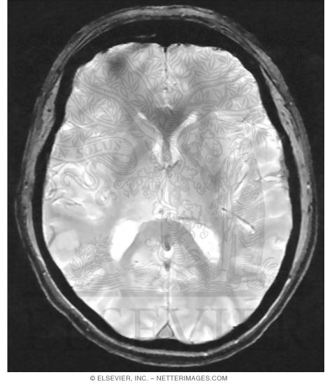 GRE MRI