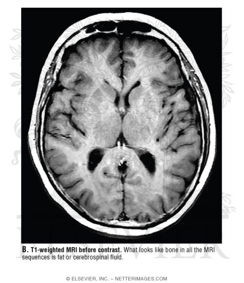 T1-Weighted MRI Before Contrast