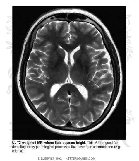 T2-Weighted MRI