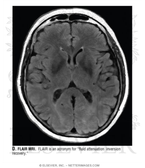 Watermarked preview of unlabeled image: FLAIR MRI