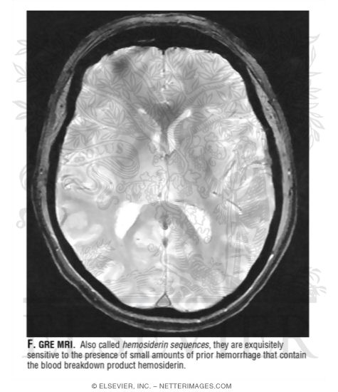 Watermarked preview of unlabeled image: GRE MRI