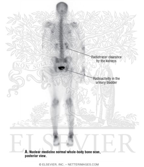 Watermarked preview of unlabeled image: Nuclear Medicine Normal Whole-Body Bone Scan, Posterior View