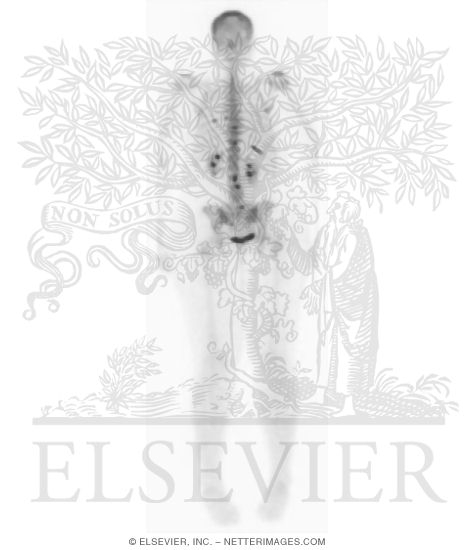 Whole-body Bone Scan, Posterior View, From a Patient With Breast Cancer Metastases to Some Posterior Ribs and Vertebral Bodies