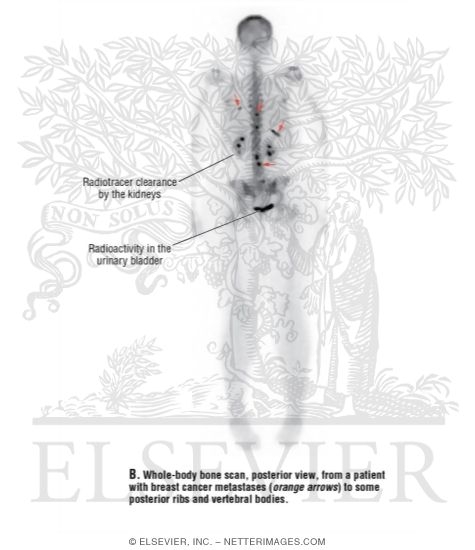 Watermarked preview of unlabeled image: Whole-body Bone Scan, Posterior View, From a Patient With Breast Cancer Metastases to Some Posterior Ribs and Vertebral Bodies