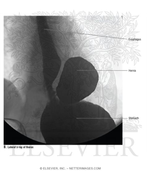 Watermarked preview of unlabeled image: Lateral X-Ray of Thorax