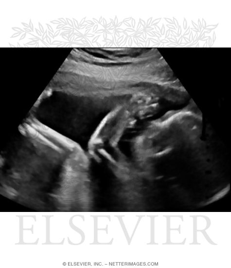 Ultrasound Image of a Second-Trimester Fetus