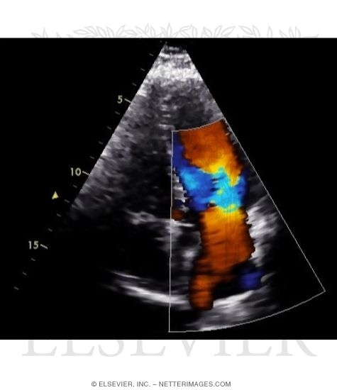 Color Doppler Ultrasound Image of Blood Flowing From Left Atrium Into the Left Ventricle