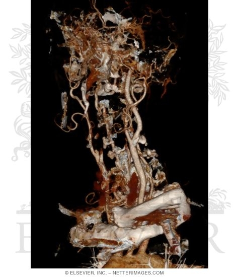 Watermarked preview of unlabeled image: CT Angiogram of Neck Arteries With a Left Anterior Oblique (LAO) View of 30 Degrees