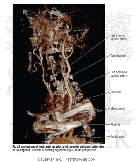 CT Angiogram of Neck Arteries With a Left Anterior Oblique ...