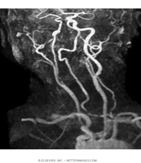 Watermarked preview of unlabeled image: MR Angiogram Using MIP Algorithm