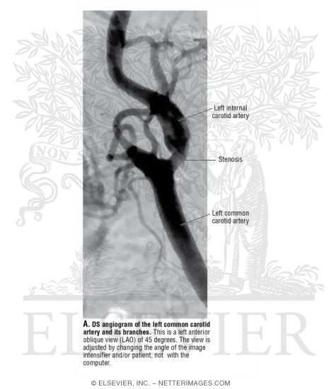 Watermarked preview of unlabeled image: DS Angiogram of the Left Common Carotid Artery and Its Branches