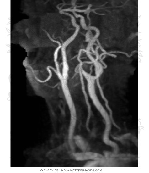 MR Angiogram at a 45-Degree Left Anterior Oblique (LAO) View