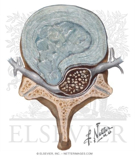 Schematic Cross Section Showing Compression of Nerve Root