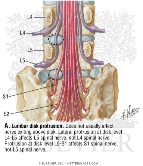 Lumbar Disk Protrusion