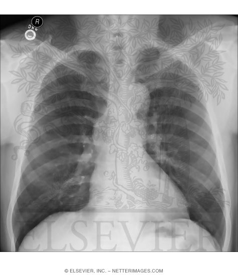 Male Posteroanterior X-Ray