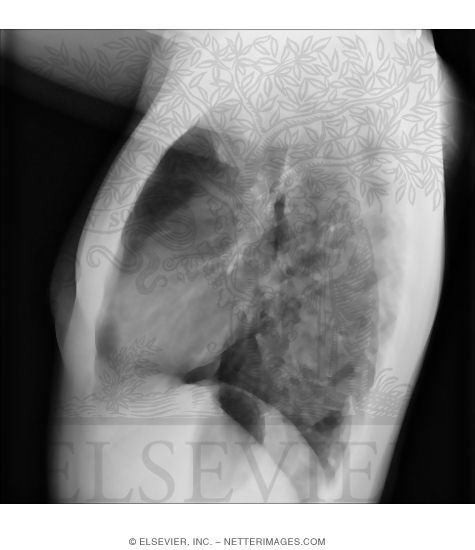 Lateral X-Ray of the Lung