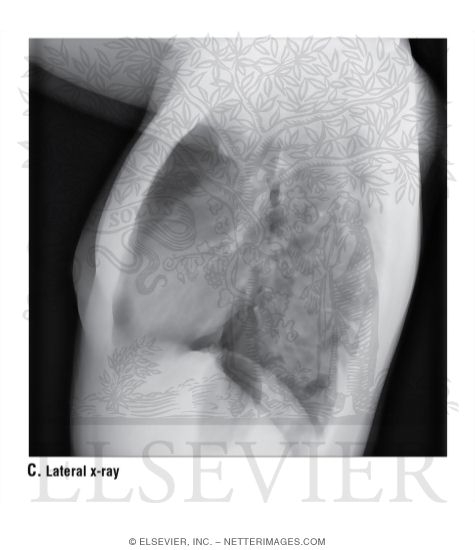 Watermarked preview of unlabeled image: Lateral X-Ray of the Lung