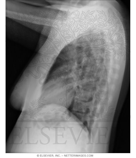Lateral Chest X-Ray, Female