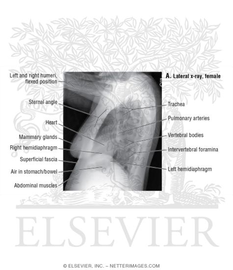 Lateral Chest X-Ray, Female