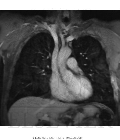 Coronal MR Image of the Heart