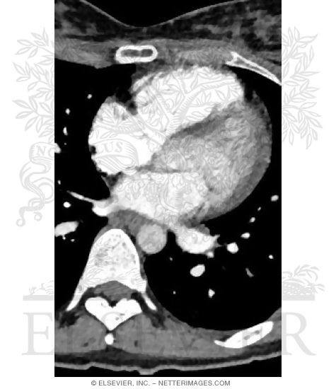 Watermarked preview of unlabeled image: CT of T8