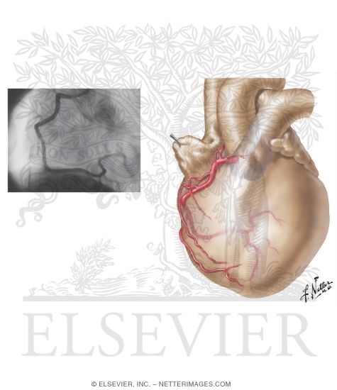 Right Coronary Artery: Left Anterior Oblique View