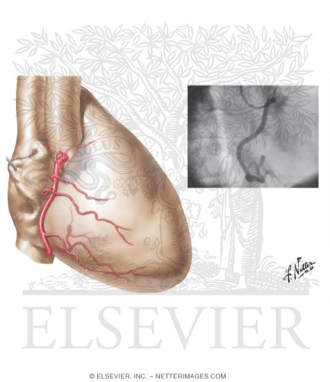 Right Coronary Artery: Right Anterior Oblique View