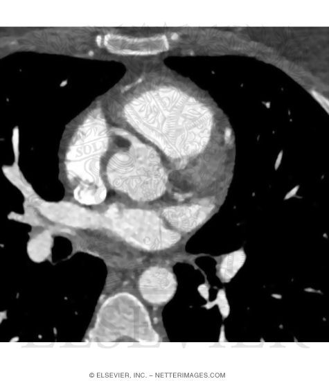Watermarked preview of unlabeled image: Cardiac CT Showing the Origin of the Right Coronary Artery of the Aorta