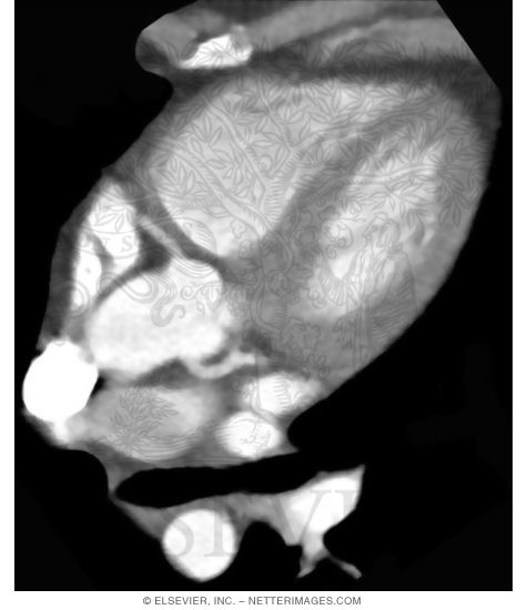 Watermarked preview of unlabeled image: Oblique CT Reconstruction Showing the Origin of Both the Right and Left Coronary Arteries